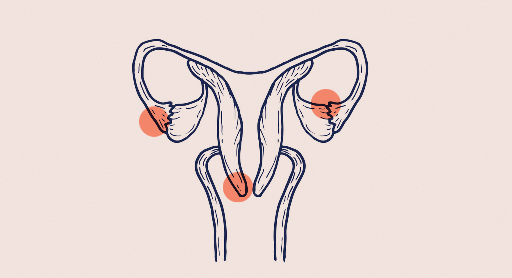 Внематочная беременность 